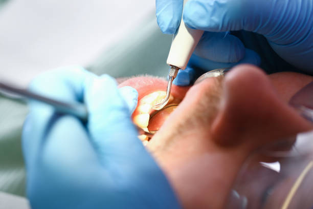 Best Emergency Tooth Extraction in Csar Chvez, TX